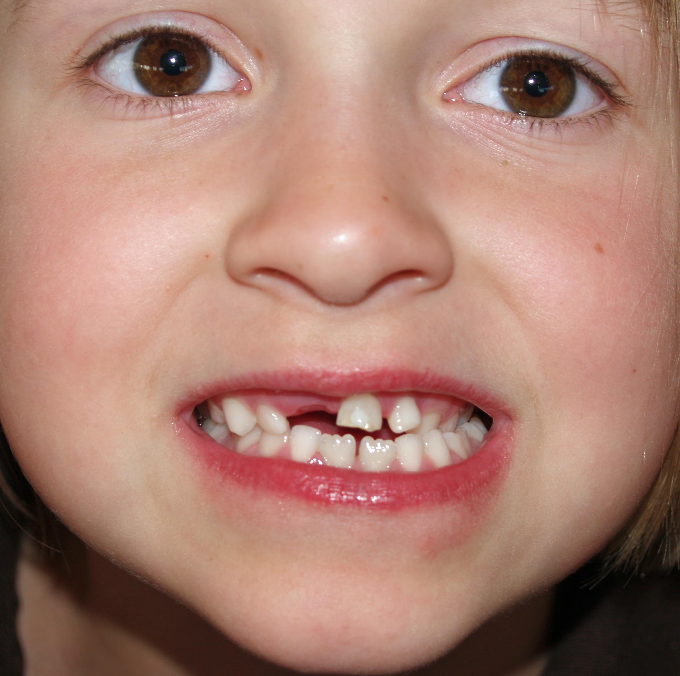 Skift fra ‌melketenner ⁣til permanente tenner: En ‌naturlig ‍del ⁤av ⁤utviklingen ⁣hos⁤ barn